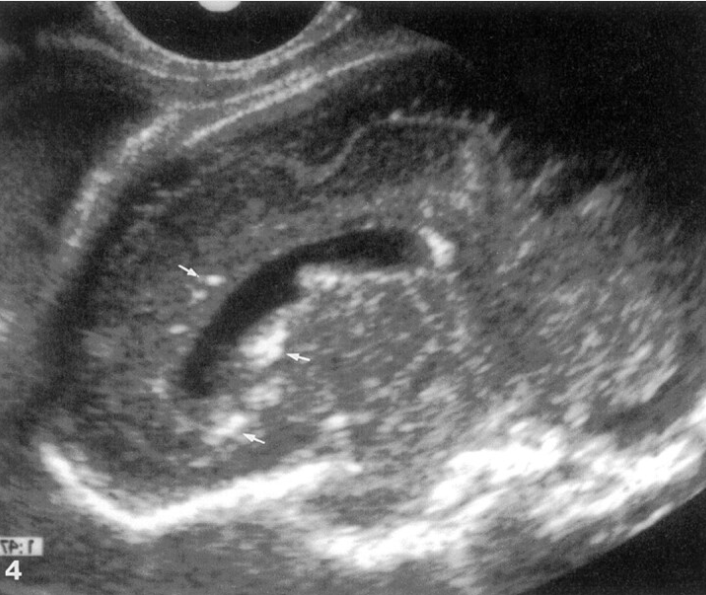 Calcificação cerebral em infecção congênita
